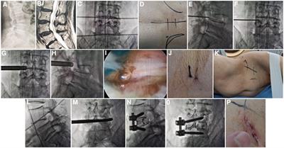 Percutaneous transforaminal endoscopic surgery combined with mini-incision OLIF and anterolateral screws rod fixation vs. MIS-TLIF for surgical treatment of single-level lumbar spondylolisthesis